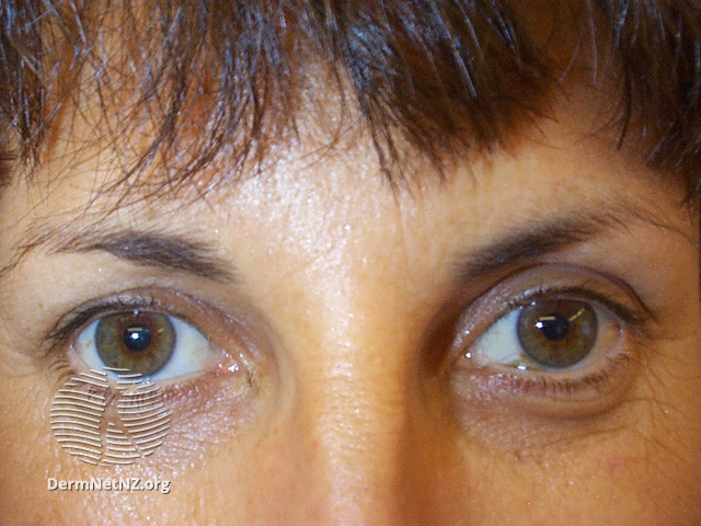 File:Subject relaxed after botulinum toxin injections (DermNet NZ procedures-no-frown-botox).jpg