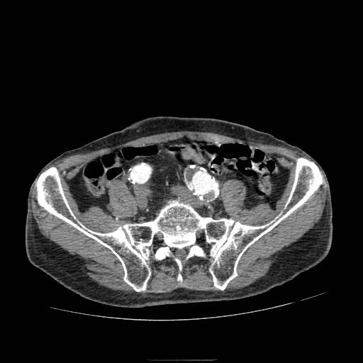 File:Abdominal aortic aneurysm (Radiopaedia 13341-13340 Axial C+ arterial phase 176).jpg