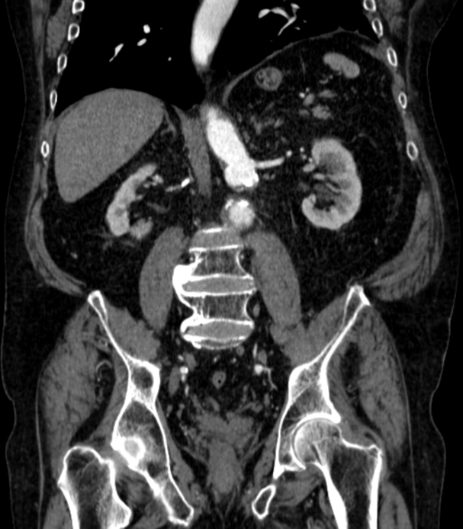 Abdominal aortic aneurysm (Radiopaedia 25855-26001 Coronal C+ arterial phase 44).jpg