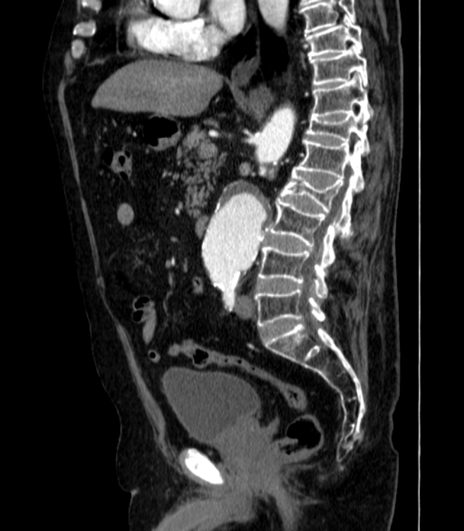 Abdominal aortic aneurysm (Radiopaedia 25855-26001 Sagittal C+ arterial phase 27).jpg
