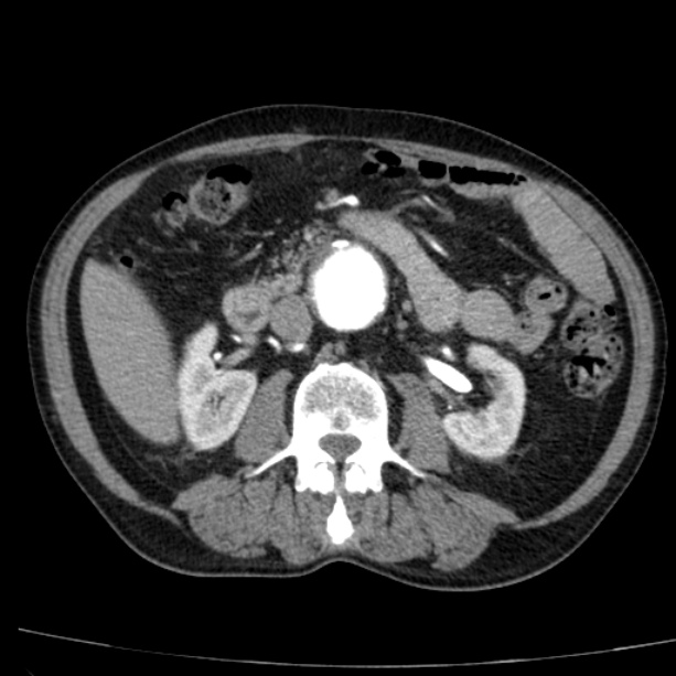 Abdominal aortic aneurysm (Radiopaedia 29248-29660 Axial C+ arterial phase 38).jpg