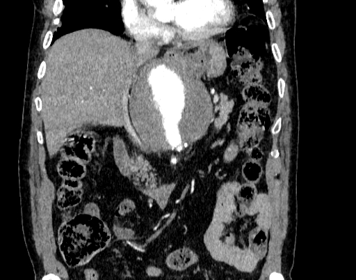 Abdominal aortic aneurysm (Radiopaedia 67117-76452 Coronal C+ arterial phase 37).jpg