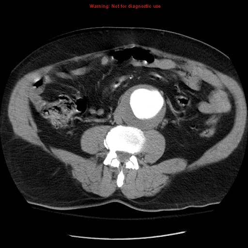 Abdominal aortic aneurysm (Radiopaedia 8190-9038 Axial C+ arterial phase 47).jpg