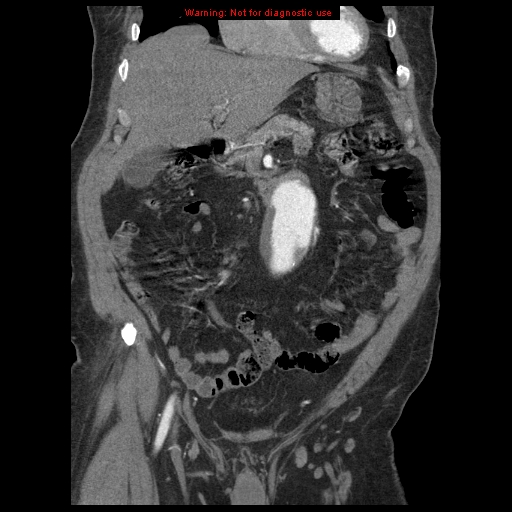 Abdominal aortic aneurysm (Radiopaedia 8190-9038 Coronal C+ arterial phase 40).jpg