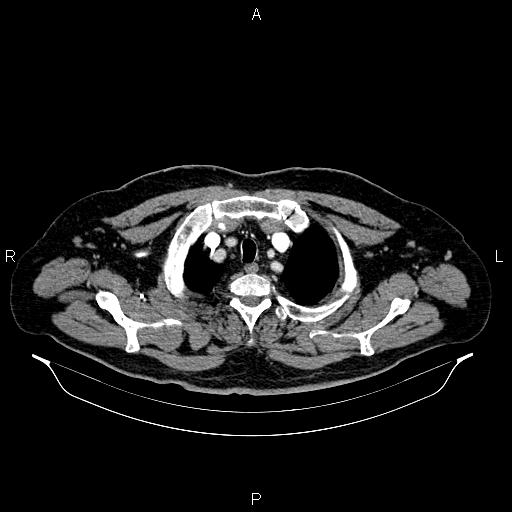 Abdominal aortic aneurysm (Radiopaedia 83094-97462 Axial renal cortical phase 11).jpg
