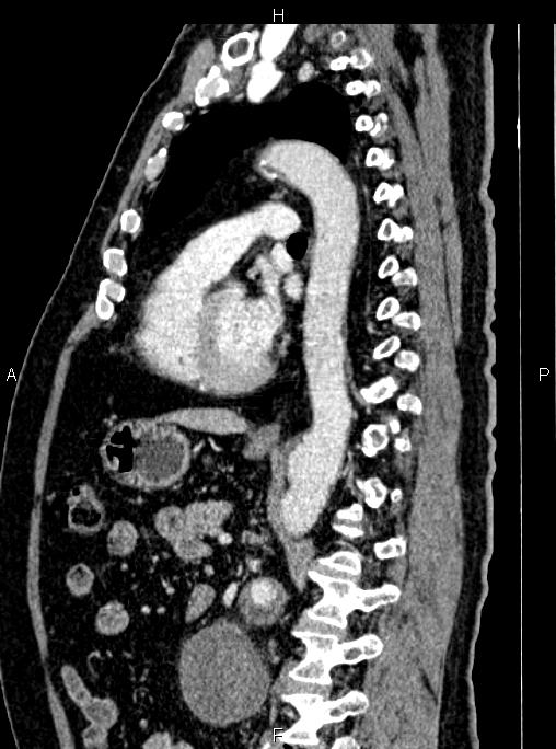 Abdominal aortic aneurysm (Radiopaedia 83094-97462 Sagittal renal cortical phase 73).jpg