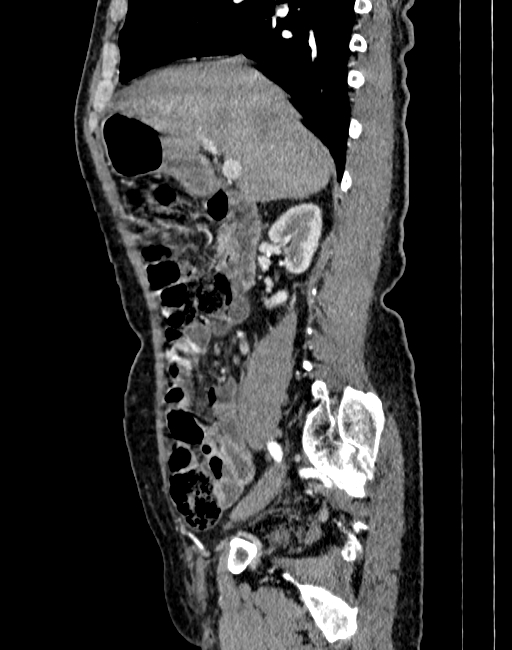 Abdominal aortic aneurysm (Radiopaedia 83581-98689 Sagittal C+ arterial phase 11).jpg