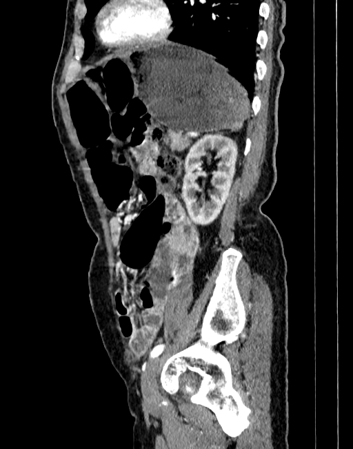 Abdominal aortic aneurysm (Radiopaedia 83581-98689 Sagittal C+ arterial phase 90).jpg