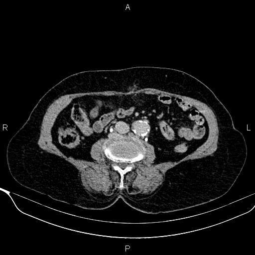 Abdominal aortic aneurysm (Radiopaedia 85063-100606 Axial C+ delayed 71).jpg