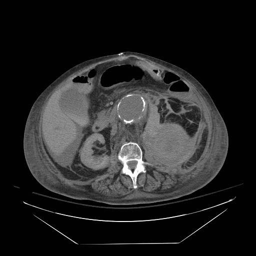 Abdominal aortic aneurysm - impending rupture (Radiopaedia 19233-19247 Axial non-contrast 82).jpg