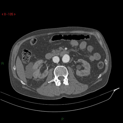 Abdominal aortic aneurysm rupture with aortocaval fistula (Radiopaedia 14897-14841 Axial C+ arterial phase 105).jpg