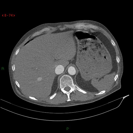 File:Abdominal aortic aneurysm rupture with aortocaval fistula (Radiopaedia 14897-14841 Axial C+ arterial phase 74).jpg