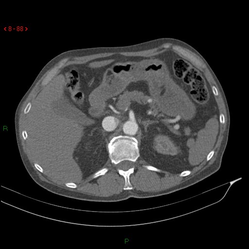 File:Abdominal aortic aneurysm rupture with aortocaval fistula (Radiopaedia 14897-14841 Axial C+ arterial phase 88).jpg