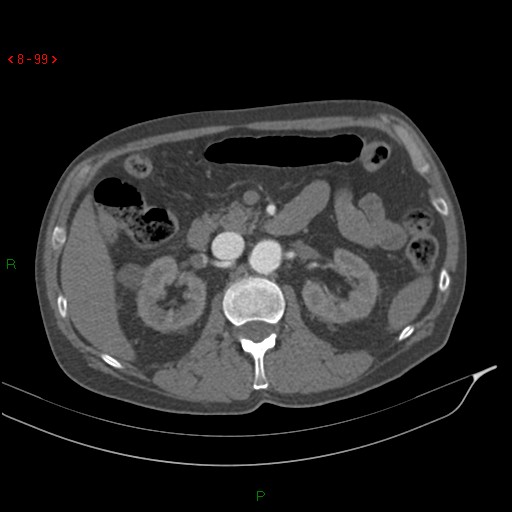 File:Abdominal aortic aneurysm rupture with aortocaval fistula (Radiopaedia 14897-14841 Axial C+ arterial phase 99).jpg
