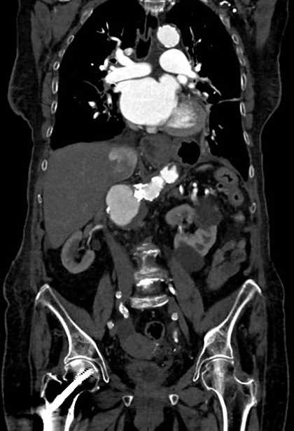 Abdominal aortic aneurysm with thrombus fissuration (Radiopaedia 73192-83919 Coronal C+ arterial phase 45).jpg
