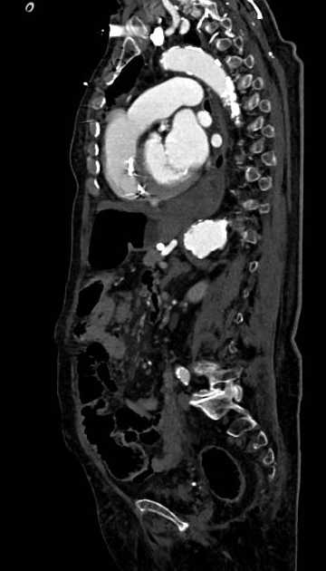 Abdominal aortic aneurysm with thrombus fissuration (Radiopaedia 73192-83919 Sagittal C+ arterial phase 55).jpg
