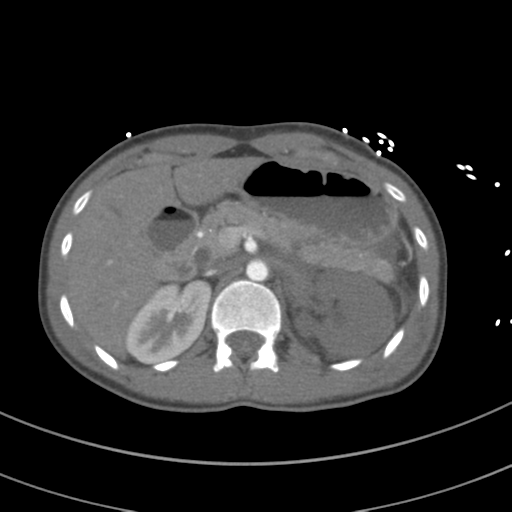 Abdominal multi-trauma - devascularised kidney and liver, spleen and pancreatic lacerations (Radiopaedia 34984-36486 Axial C+ arterial phase 99).png