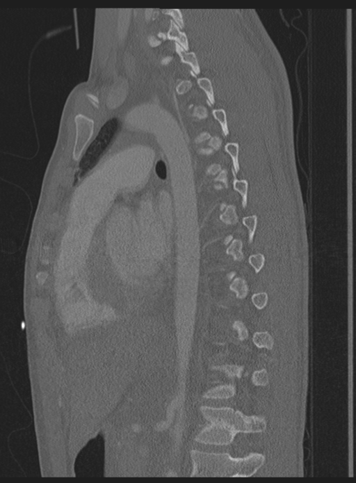 Abdominal multi-trauma - devascularised kidney and liver, spleen and pancreatic lacerations (Radiopaedia 34984-36486 Sagittal bone window 23).png