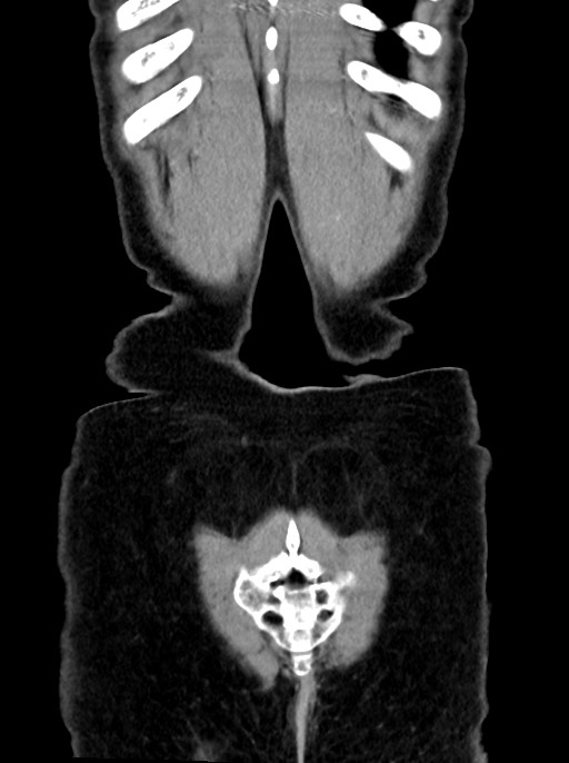 Abdominal wall and retroperitoneal tuberculosis (Radiopaedia 88137-104729 Coronal C+ portal venous phase 97).jpg