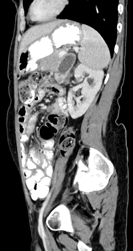 Abdominal wall and retroperitoneal tuberculosis (Radiopaedia 88137-104729 Sagittal C+ portal venous phase 50).jpg