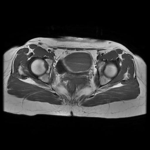 File:Abdominal wall endometriosis (Radiopaedia 83702-98847 Axial T1 13).jpg