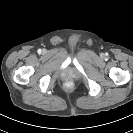 Abdominal wall metastasis from colorectal carcinoma (Radiopaedia 31016-31717 Axial C+ portal venous phase 80).jpg