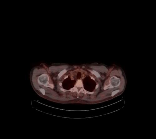 Abdominal wall metastasis from colorectal carcinoma (Radiopaedia 31016-31719 C 126).jpg