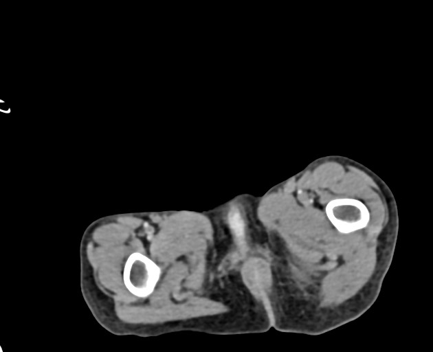 Abdominopelvic rhabdomyosarcoma (Radiopaedia 78356-90984 Axial C+ portal venous phase 165).jpg