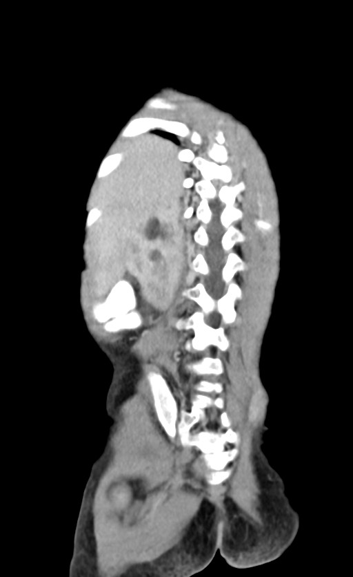 Abdominopelvic rhabdomyosarcoma (Radiopaedia 78356-90984 Coronal C+ portal venous phase 79).jpg