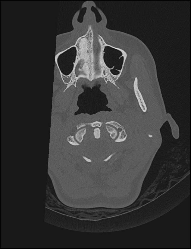 Aberrant right internal carotid artery (Radiopaedia 65191-74198 Axial non-contrast 2).jpg