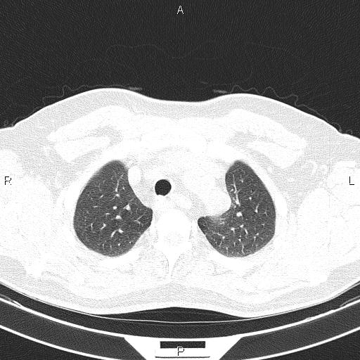 Aberrant right subclavian artery (Radiopaedia 87093-103354 Axial lung window 22).jpg