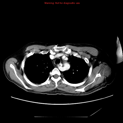 Aberrant right subclavian artery (Radiopaedia 9379-10071 Axial C+ arterial phase 17).jpg