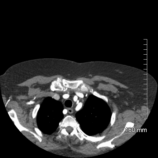 Aberrant right subclavian artery stenosis (Radiopaedia 52656-58670 Axial C+ arterial phase 16).jpg