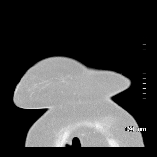 Aberrant right subclavian artery stenosis (Radiopaedia 52656-58670 B 8).jpg