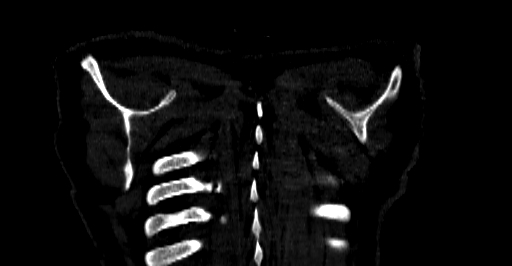 Accesory rib joint (Radiopaedia 71987-82452 Coronal bone window 90).jpg