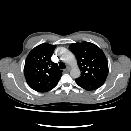 Accessory left horizontal fissure with lingular pneumonia (Radiopaedia 53763-59843 Axial C+ CTPA 30).jpg