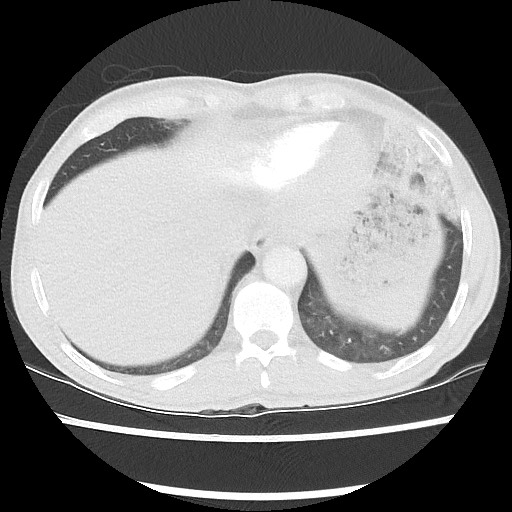 Accessory left horizontal fissure with lingular pneumonia (Radiopaedia 53763-59843 Axial lung window 46).jpg