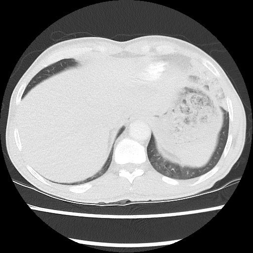 Accessory left horizontal fissure with lingular pneumonia (Radiopaedia 53763-59843 Axial lung window 47).jpg