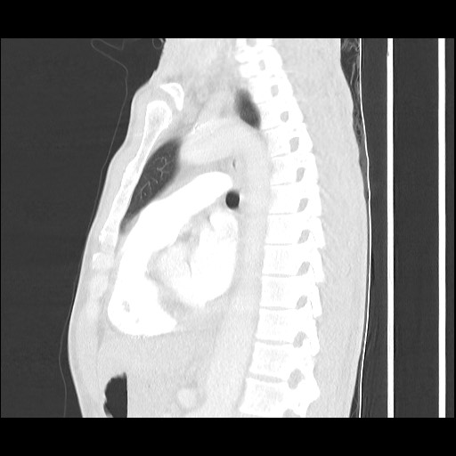 File:Accessory left horizontal fissure with lingular pneumonia (Radiopaedia 53763-59843 Sagittal lung window 39).jpg