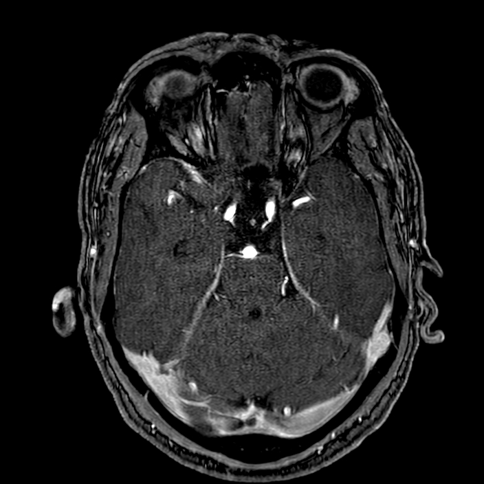 Accessory middle cerebral artery (Radiopaedia 73114-83828 Axial MRA 62).jpg