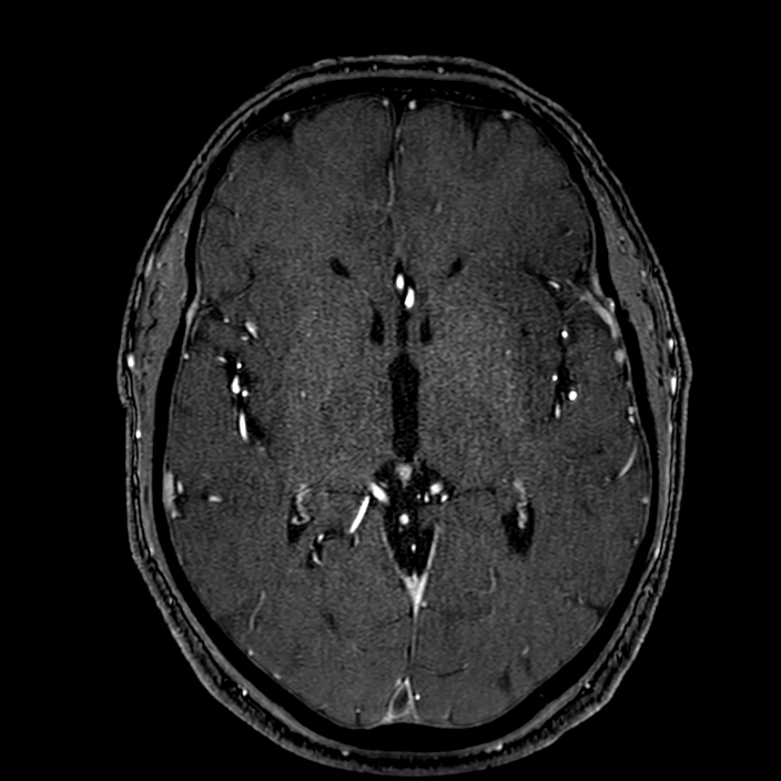 Accessory middle cerebral artery (Radiopaedia 73114-83828 Axial MRA 99).jpg