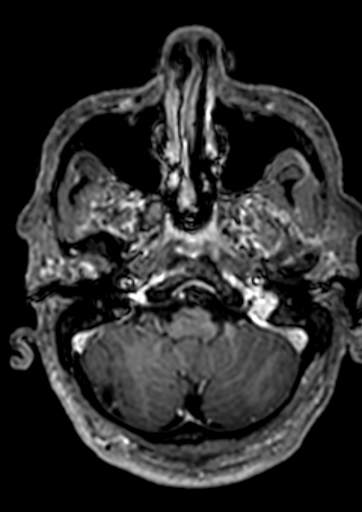 Accessory middle cerebral artery (Radiopaedia 73114-83828 Axial T1 C+ 151).jpg