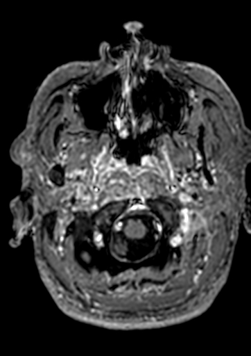 Accessory middle cerebral artery (Radiopaedia 73114-83828 Axial T1 C+ 187).jpg