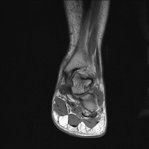File:Achilles tendon tear (Radiopaedia 77615-89819 Coronal T1 13).jpg