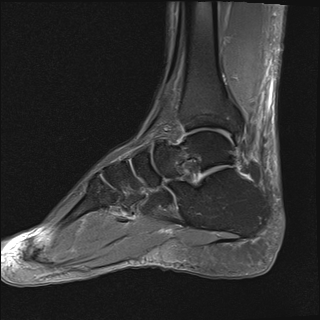 File:Achilles tendon tear (Radiopaedia 77615-89819 Sagittal PD fat sat 14).jpg