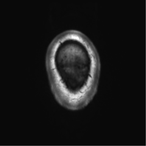 File:Achondroplasia (Radiopaedia 65109-74105 Axial T1 2).png