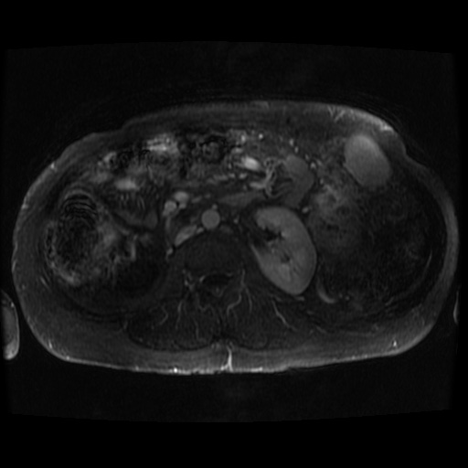 Acinar cell carcinoma of the pancreas (Radiopaedia 75442-86668 Axial T1 C+ fat sat 18).jpg