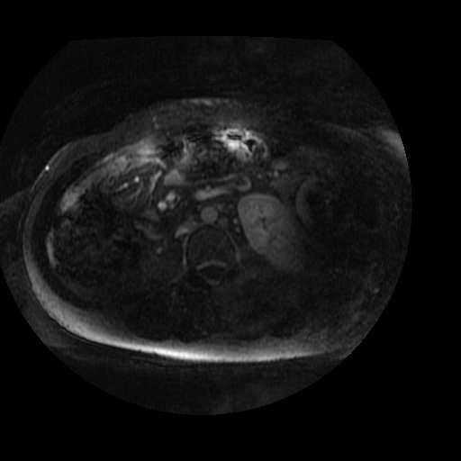 Acinar cell carcinoma of the pancreas (Radiopaedia 75442-86668 Axial T1 C+ fat sat 5).jpg