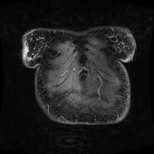 Acinar cell carcinoma of the pancreas (Radiopaedia 75442-86668 Coronal T1 C+ fat sat 176).jpg