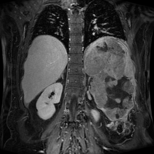 Acinar cell carcinoma of the pancreas (Radiopaedia 75442-86668 Coronal T1 C+ fat sat 60).jpg